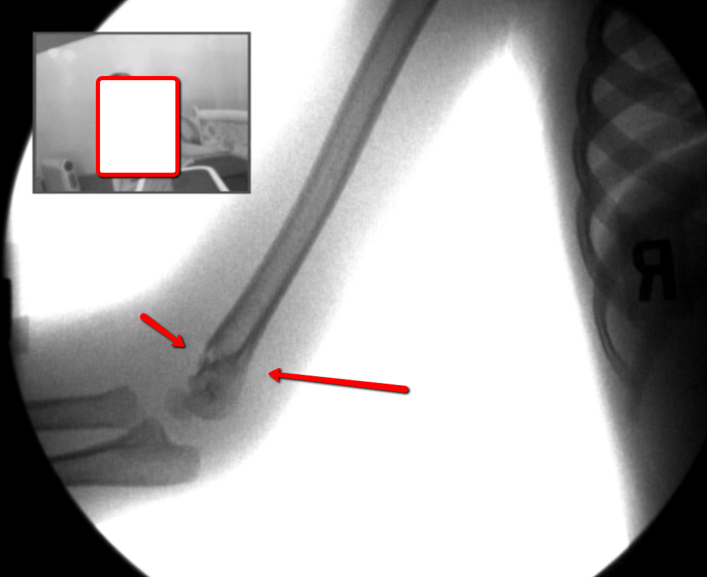 DMX_Left_Lateral_Distal_Humeral_Head